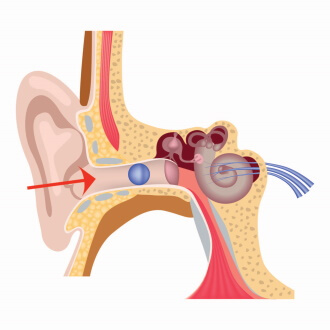 Инородное тело уха